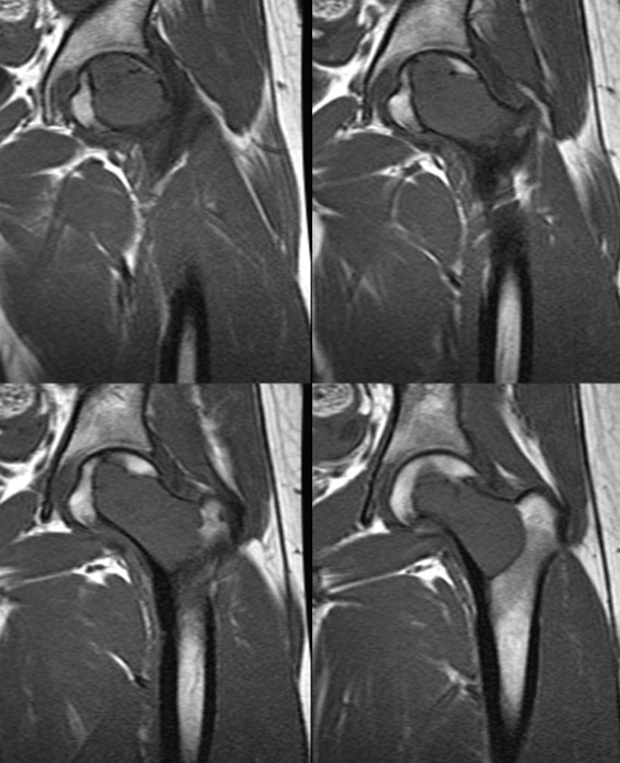 Figure 3 for case Clear cell chondrosarcoma ( RID4142 )